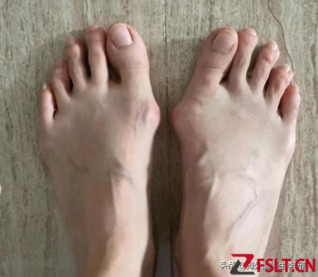 廣東寶媽生孩子后拇外翻加重來做手術(shù)，一起看看恢復(fù)情況吧！